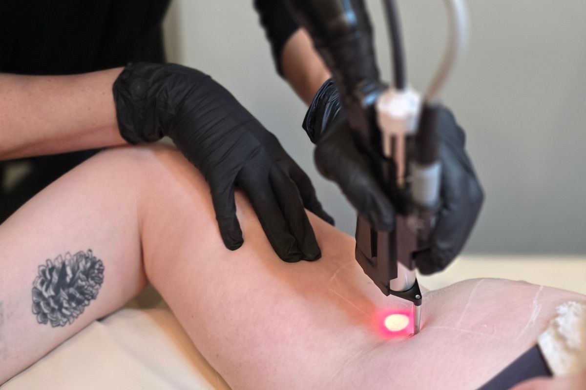 patient receiving laser hair removal treatment