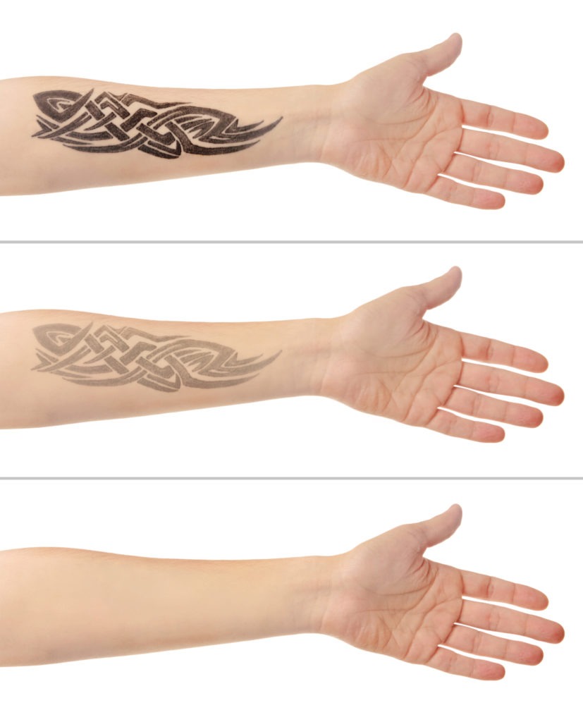 Laser Tattoo Removal - Silhouette Spa & Laser