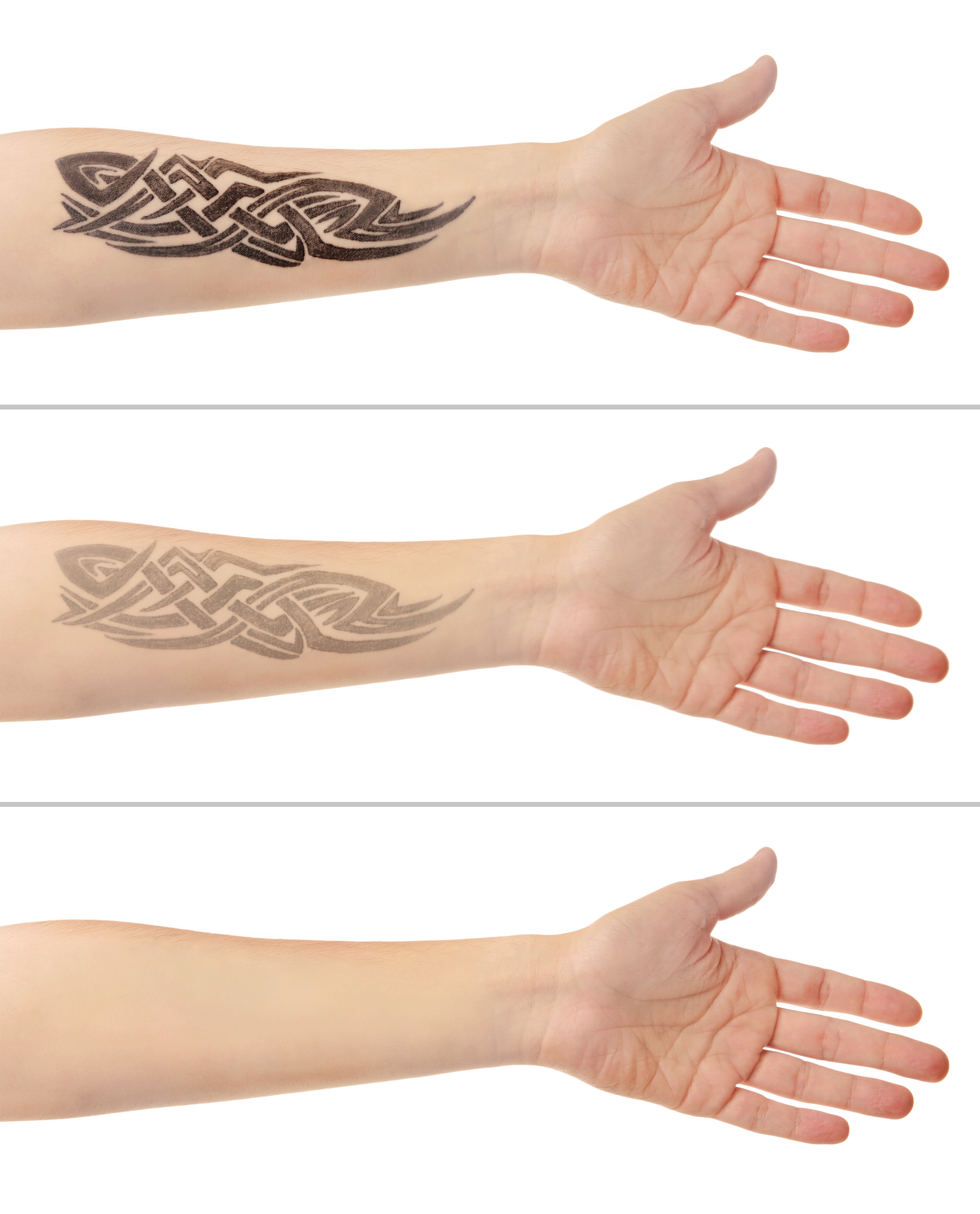 Laser Tattoo Removal  EGO Beauty Westminster London